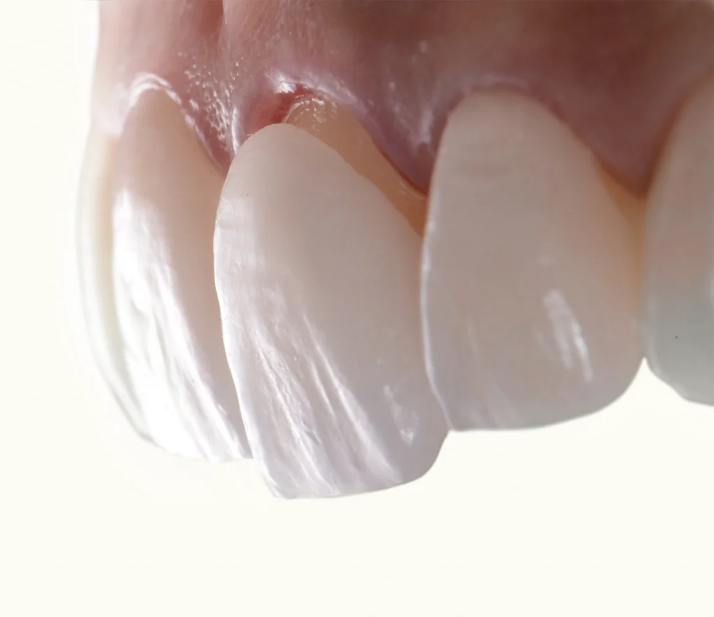 The Lifespan Of Veneers And How To Make Them Last